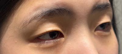눈 감았다 뜨니 끝나 있었고 통증도 거의 없었어요 사진 2 — 아바성형외과 쌍꺼풀·눈성형 후기