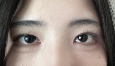 눈 감았다 뜨니 끝나 있었고 통증도 거의 없었어요 사진 4 — 아바성형외과 쌍꺼풀·눈성형 후기