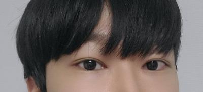 아바성형외과 눈수술 후기, 안경 벗고 시원해요 — 아바성형외과 환자 후기 사진