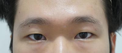 아바성형외과 눈수술 후기, 안경 벗고 시원해요 사진 2 — 아바성형외과 쌍꺼풀·눈성형 후기