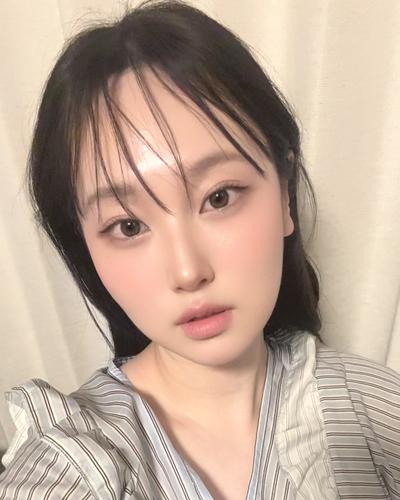 한달 반 지나니 붓기 완전히 빠졌어요, 더 일찍 할걸 — 아바성형외과 환자 후기 사진