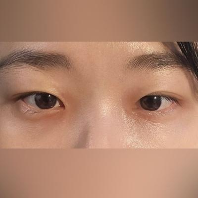 눈성형 환자 후기 — 직후에는 걱정될 정도로 붓고... (368)
