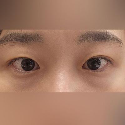 눈밑지방재배치 후기, 짝짝이 맞춰지고 얼굴 나이가 확 어려졌어요 사진 2 — 아바성형외과 눈밑지방재배치 후기