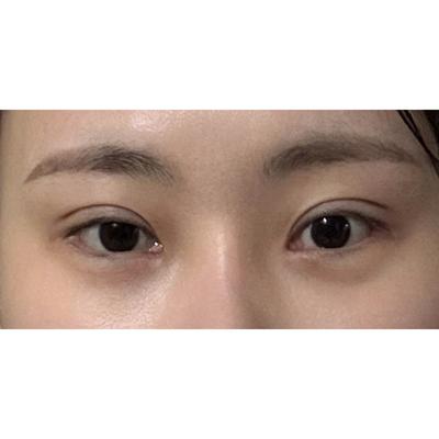 눈밑지방재배치 쌍꺼풀 재수술 6주차, 인상이 확 밝아졌어요 — 아바성형외과 환자 후기 사진