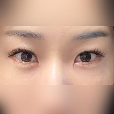 눈밑지방재배치 4주차, 울퉁불퉁했던 눈밑 깔끔해졌어요 사진 1 — 아바성형외과 눈밑지방재배치 후기