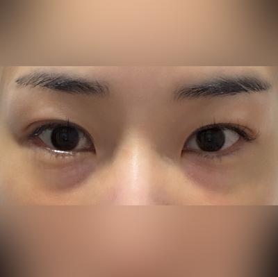 눈밑지방재배치 4주차, 울퉁불퉁했던 눈밑 깔끔해졌어요 사진 2 — 아바성형외과 눈밑지방재배치 후기