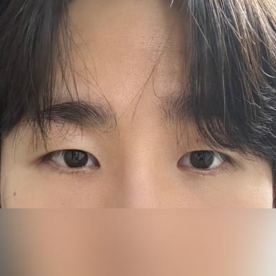 눈밑지방재배치 2주차, 20대부터 한 고민 끝냈어요 — 아바성형외과 환자 후기 사진