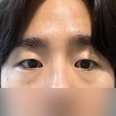 눈밑지방재배치 2주차, 20대부터 한 고민 끝냈어요 사진 2 — 아바성형외과 눈밑지방재배치 후기