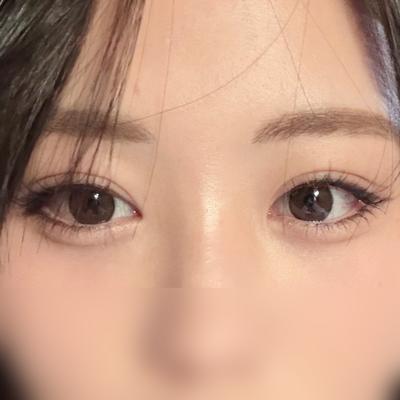 눈밑지방재배치 8주차, 눈밑고랑 다크서클이 확 옅어졌어요 — 아바성형외과 환자 후기 사진