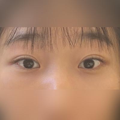 눈성형 환자 후기 — ★브라운성형외과★ ★4주★
... (372)