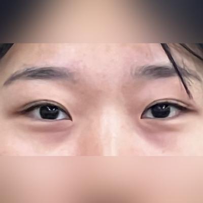 눈밑지방재배치 4주차, 짝짝이도 잡히고 눈가가 확 환해졌어요 사진 2 — 아바성형외과 눈밑지방재배치 후기