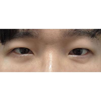 시술 8주차, 이제 완전히 자리잡아서 만족스러워요 사진 4 — 아바성형외과 기타 후기