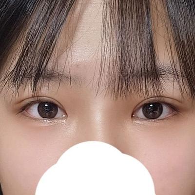 매몰 쌍꺼풀＋트임 8주차, 상담한 라인 그대로 나왔어요 — 아바성형외과 환자 후기 사진