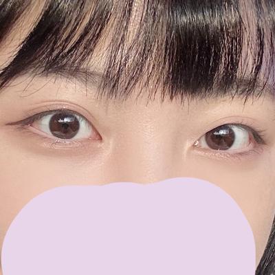 눈밑지방 6주차, 다크서클까지 사라져서 너무 만족해요 — 아바성형외과 환자 후기 사진