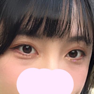 눈밑지방 6주차, 다크서클까지 사라져서 너무 만족해요 사진 3 — 아바성형외과 눈밑지방재배치 후기