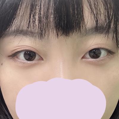 눈밑지방 6주차, 다크서클까지 사라져서 너무 만족해요 사진 4 — 아바성형외과 눈밑지방재배치 후기