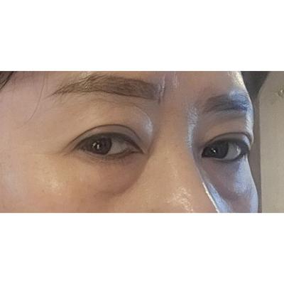 눈밑지방재배치 4주차, 멍자국만 남고 아주 좋아요 사진 2 — 아바성형외과 눈밑지방재배치 후기