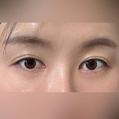 눈밑지방재배치 2개월차, 원래 눈밑이 기억도 안 날 정도예요 — 아바성형외과 환자 후기 사진