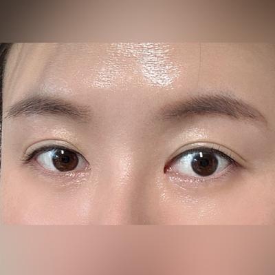 눈밑지방재배치 2개월차, 원래 눈밑이 기억도 안 날 정도예요 사진 4 — 아바성형외과 눈밑지방재배치 후기