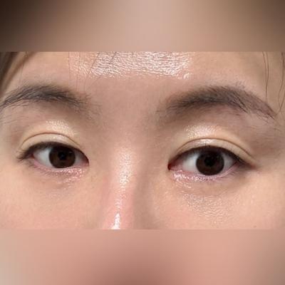 눈밑지방재배치 6주차, 뒤밑트임 재수술까지 성공했어요 — 아바성형외과 환자 후기 사진