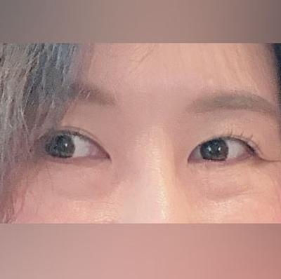 눈밑지방재배치 6주차, 뒤밑트임 재수술까지 성공했어요 사진 3 — 아바성형외과 눈밑지방재배치 후기