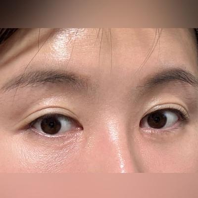 눈밑지방재배치 6주차, 뒤밑트임 재수술까지 성공했어요 사진 4 — 아바성형외과 눈밑지방재배치 후기