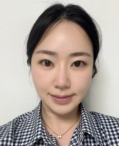 눈밑지방 2주차, 붓기 빠지고 눈밑 확실히 깔끔해졌어요 — 아바성형외과 환자 후기 사진