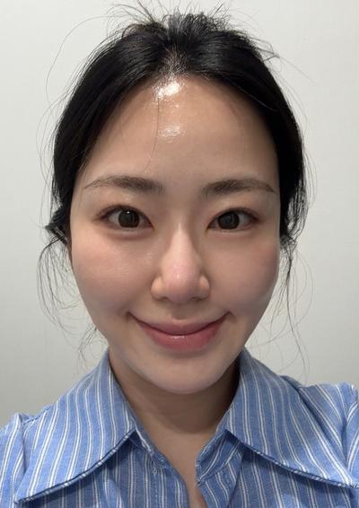 눈밑지방 2주차, 붓기 빠지고 눈밑 확실히 깔끔해졌어요 사진 2 — 아바성형외과 눈밑지방재배치 후기