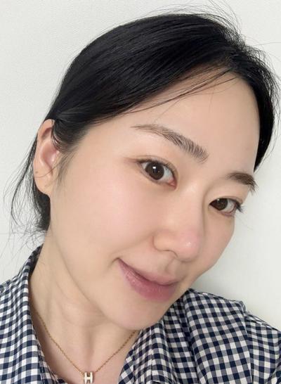 눈밑지방 2주차, 붓기 빠지고 눈밑 확실히 깔끔해졌어요 사진 4 — 아바성형외과 눈밑지방재배치 후기