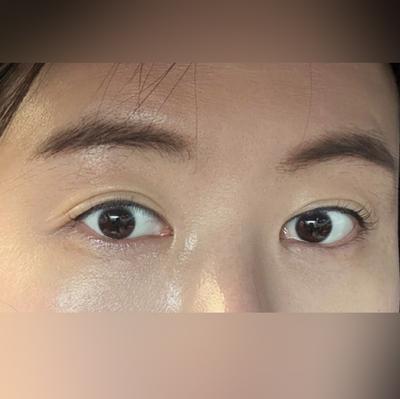 눈밑지방재배치 4주차, 거울 볼 때마다 너무 좋아요 강추 — 아바성형외과 환자 후기 사진