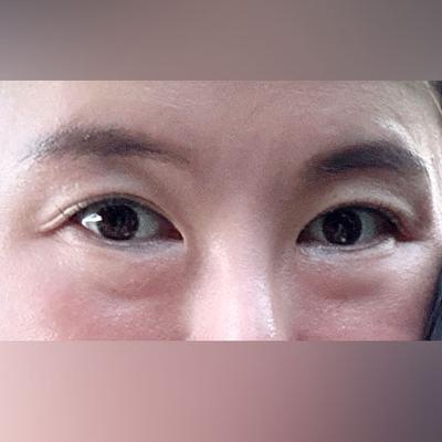 눈밑지방재배치 4주차, 거울 볼 때마다 너무 좋아요 강추 사진 2 — 아바성형외과 눈밑지방재배치 후기