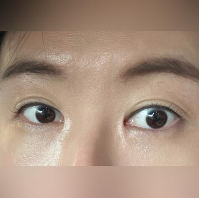 눈밑지방재배치 4주차, 거울 볼 때마다 너무 좋아요 강추 사진 4 — 아바성형외과 눈밑지방재배치 후기
