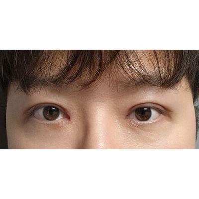 남자 절개 눈수술 6주차, 붓기 빠지니 후회 없이 만족이에요 — 아바성형외과 환자 후기 사진
