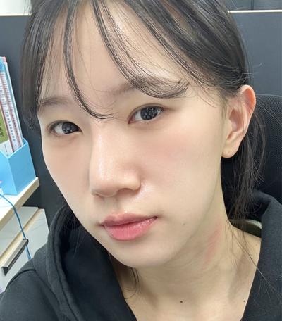 수술 후 딱 이틀만 불편, 2주 만에 일상 복귀했어요 사진 1 — 아바성형외과 기타 후기