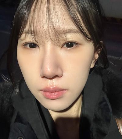 수술 후 딱 이틀만 불편, 2주 만에 일상 복귀했어요 사진 4 — 아바성형외과 기타 후기