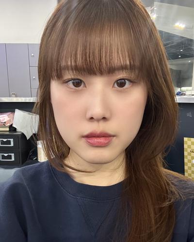 눈밑지방재배치 10주차, 짝짝이 애교살 밸런스까지 만족 — 아바성형외과 환자 후기 사진