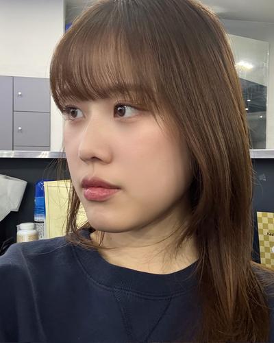 눈밑지방재배치 10주차, 짝짝이 애교살 밸런스까지 만족 사진 6 — 아바성형외과 눈밑지방재배치 후기