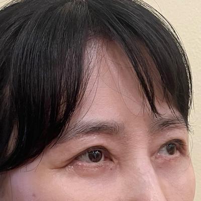 눈밑지방재배치 6주차, 갈수록 자연스러워지고 초점도 돌아와요 — 아바성형외과 환자 후기 사진