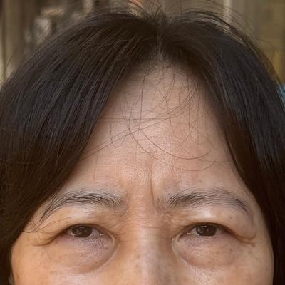 눈밑지방재배치 6주차, 갈수록 자연스러워지고 초점도 돌아와요 사진 2 — 아바성형외과 눈밑지방재배치 후기