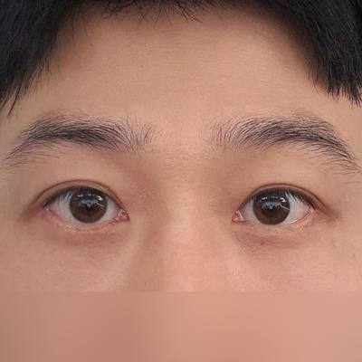 눈밑지방재배치＋하안검 8주차, 피곤해 보인다는 말 사라졌어요 — 아바성형외과 환자 후기 사진
