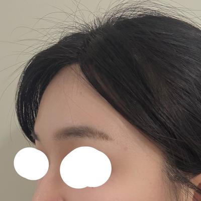6주차, 선이 부드러워지고 컴플렉스 완전 사라졌어요 — 아바성형외과 환자 후기 사진