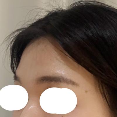 6주차, 선이 부드러워지고 컴플렉스 완전 사라졌어요 사진 2 — 아바성형외과 기타 후기