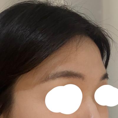 6주차, 선이 부드러워지고 컴플렉스 완전 사라졌어요 사진 3 — 아바성형외과 기타 후기