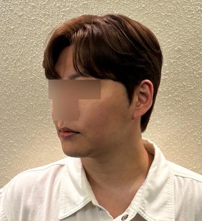 스마스거상 아큐리프팅 5주차, 얼굴 확 작아졌어요 사진 3 — 아바성형외과 안면거상 후기
