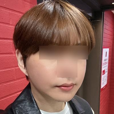 스마스거상 아큐리프팅 5주차, 얼굴 확 작아졌어요 사진 5 — 아바성형외과 안면거상 후기