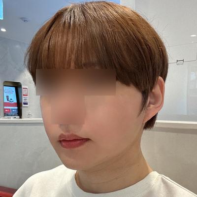 스마스거상 아큐리프팅 5주차, 얼굴 확 작아졌어요 사진 6 — 아바성형외과 안면거상 후기