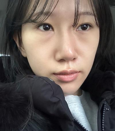 수술 4주차, 안색 밝아지고 그림자도 안 져요 진작 할 걸 사진 2 — 아바성형외과 기타 후기