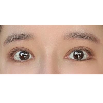 눈썹거상＋쌍꺼풀 2주차, 처진 눈가 정리되고 대만족이에요 — 아바성형외과 환자 후기 사진