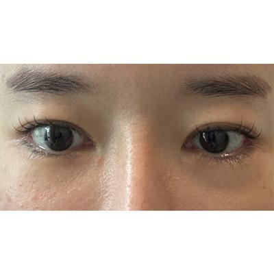 눈썹거상＋쌍꺼풀 2주차, 처진 눈가 정리되고 대만족이에요 사진 2 — 아바성형외과 안면거상 후기