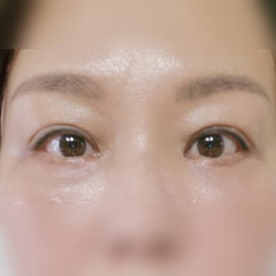 하안검 눈밑지방재배치 6주차, 어머니 눈가가 환해졌어요 — 아바성형외과 환자 후기 사진